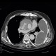 Pseudoaneurysm of aorta, replacement of ascending aorta, haemothorax: CT - Computed tomography